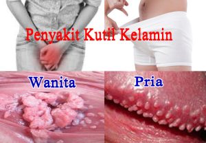 Obat Kutil Kelamin