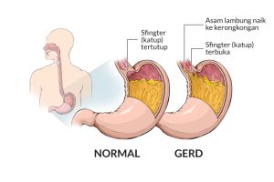 Asam Lambung