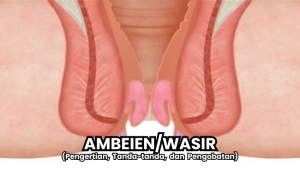 Apasi Ambeien wasir