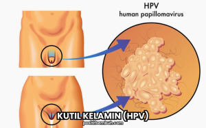 HPV Kutil Kelamin