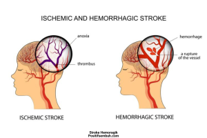 Stroke Hemoragik Positifsembuh.com