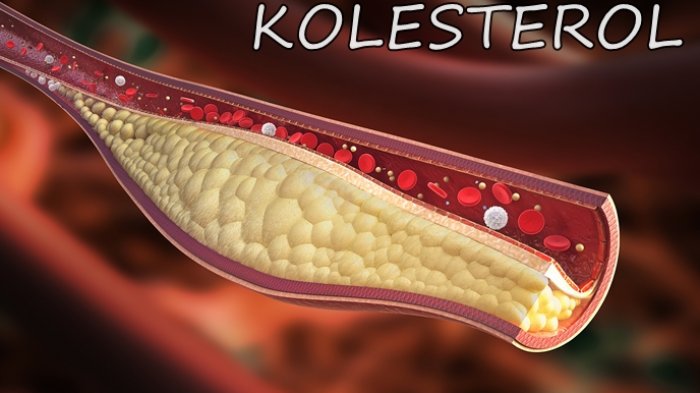 Kolesterol Tinggi Bisa Picu Terjadinya Stroke