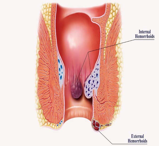 obat ampuh ambeien internal