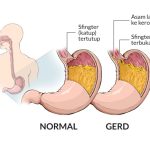 Ketahui Langkah untuk Turunkan Asam Lambung dengan Tepat dan Cepat